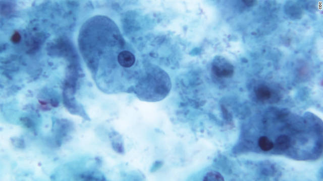 CNN's tweet photo. A mystery E. coli outbreak has sickened 72 people in 5 states, the CDC says https://t.co/ju5jv8aEoy https://t.co/Sb1OO2bN70