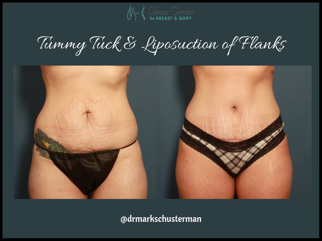 TXBreastBody's tweet photo. Tummy Tuck Transformation😍
2mo post results from our 30 yr old. mother of two, treated with Tummy Tuck and Liposuction of Flanks. 
📲 713-794-0368 💻 https://t.co/X5QKDsuFoe
#Tummytuck #Mommymakeover #Liposuction #BodyTite #houstonplasticsurgeon #texas https://t.co/YCuDphisDO