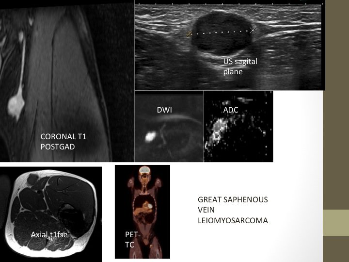 Baez1Adan's tweet photo. #MRI #RadRes #Daybydaycases #RadMSK #radiologia #radiology @MskSerme #HUNSC
Great saphenous vein leiomiosarcoma, MRI, Ultrasound, PET-CT. https://t.co/f2WU5EpjHn
