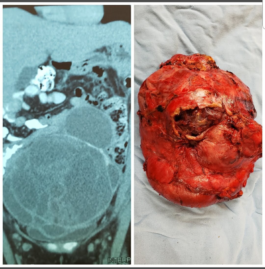 danielrojasonc1's tweet photo. Ca de ovario.
Neoadyuvancia, pobrerespuesta.
Citorreducion R0!
😷 https://t.co/Rs3nBuPvj5
