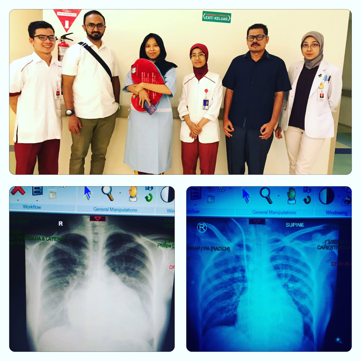 JindanFuad's tweet photo. 24 y old with RHD (mod-sev MS/MR),Giant LA,moderate PH,Atrial Flutter.S/p MVR bioprosthesis perimount valve 29 mm,LA reduction,laa closured.Discharge on POD 7, NYHA class 1, mild PH ,SR on ECG.
#Reshapetheheart,#mitralvalvesurgery,#LAreduction https://t.co/yD0MVDJUYu