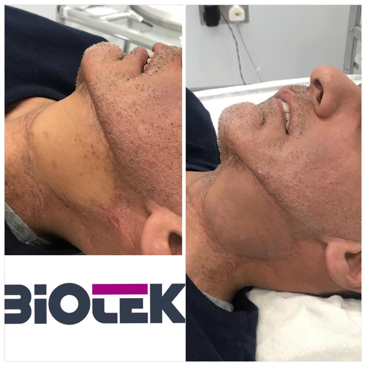 NaturalEnhance's tweet photo. Following jaw cancer and surgical reconstruction this gentleman contacted us to colour match the skin graph taken from his back to match his face colourings. Patient happy! NE happy! https://t.co/Xf82Yrxu5U