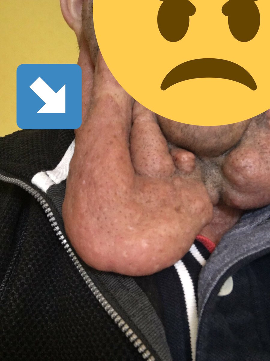 PCLaptopfixer's tweet photo. Another #Neurofibromatosis tweet,  this is a plexiform. They growth all over my body.  They are normally benign tumours which are usually non-cancerous. Affects 1 in 3000 people. Please sign, share to help find a cure for this awful condition of NF. https://t.co/a1uc7vgQPJ https://t.co/USKfrghvud