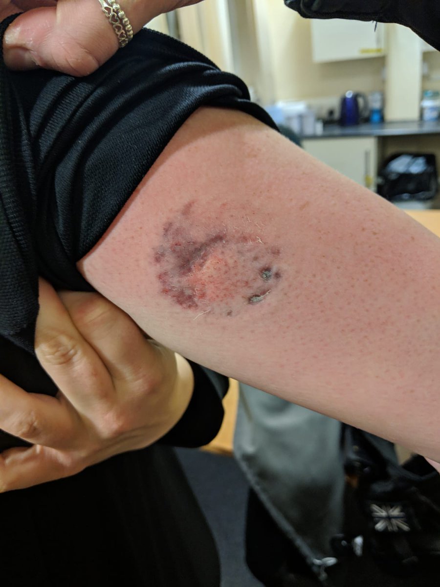 Darlo999DRelief's tweet photo. Another example of what Officers face on a daily basis. The female responsible bit through 2 layers of clothing to cause this injury and refused to let go. She bit a further officer and hit two others. Disgraceful behavior. https://t.co/OPYLKNroeG