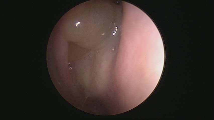 MyAllergyENT's tweet photo. #SINUVA for treatment of recurrent polyps after #FESS @DrScottFortune #nasalpolyps #Minimallyinvasiverhinology #mometasone @IntersectENT https://t.co/bikrzjbu84