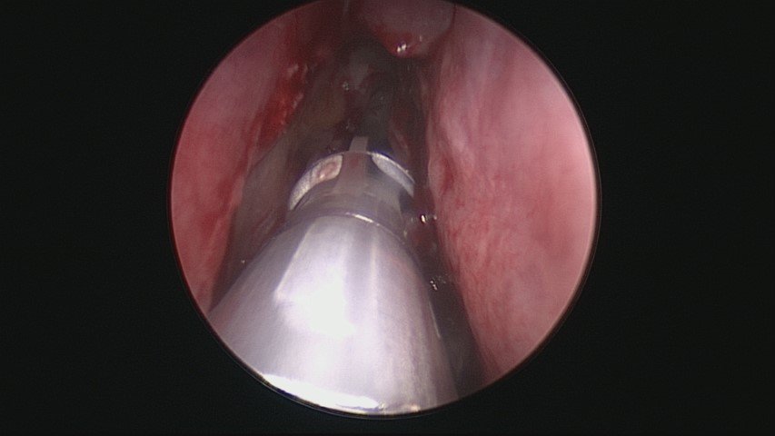 MyAllergyENT's tweet photo. #SINUVA for treatment of recurrent polyps after #FESS @DrScottFortune #nasalpolyps #Minimallyinvasiverhinology #mometasone @IntersectENT https://t.co/bikrzjbu84