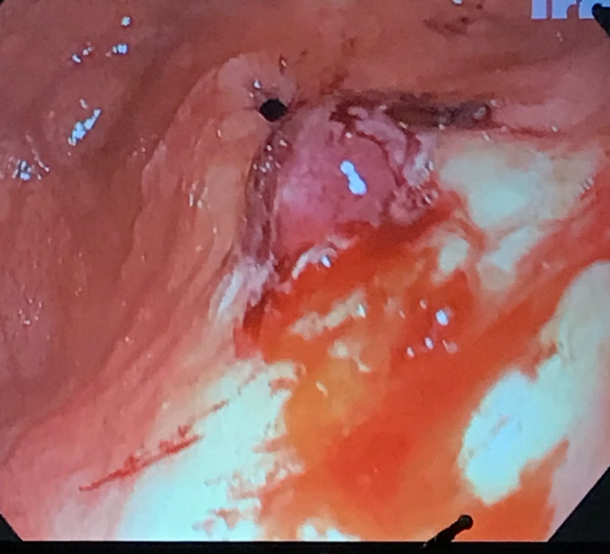 Vamsi V. Alli (@vamsialli) on Twitter photo Dr. Alfonso Lapergola of <a href="/IrcadFrance/">IrcadFrance</a> presenting a case series utilizing OTSC placement for the management of chronic defects of the aero digestive tract at #SAGES2019
#EndoscopicSurgery #FlexEndo
#Master
<a href="/SAGES_Updates/">SAGES is in Tampa in 2026!</a> <a href="/ericpaulimd/">Eric Pauli</a> Dr. Alfonso Lapergola of <a href="/IrcadFrance/">IrcadFrance</a> presenting a case series utilizing OTSC placement for the management of chronic defects of the aero digestive tract at #SAGES2019
#EndoscopicSurgery #FlexEndo
#Master
<a href="/SAGES_Updates/">SAGES is in Tampa in 2026!</a> <a href="/ericpaulimd/">Eric Pauli</a>