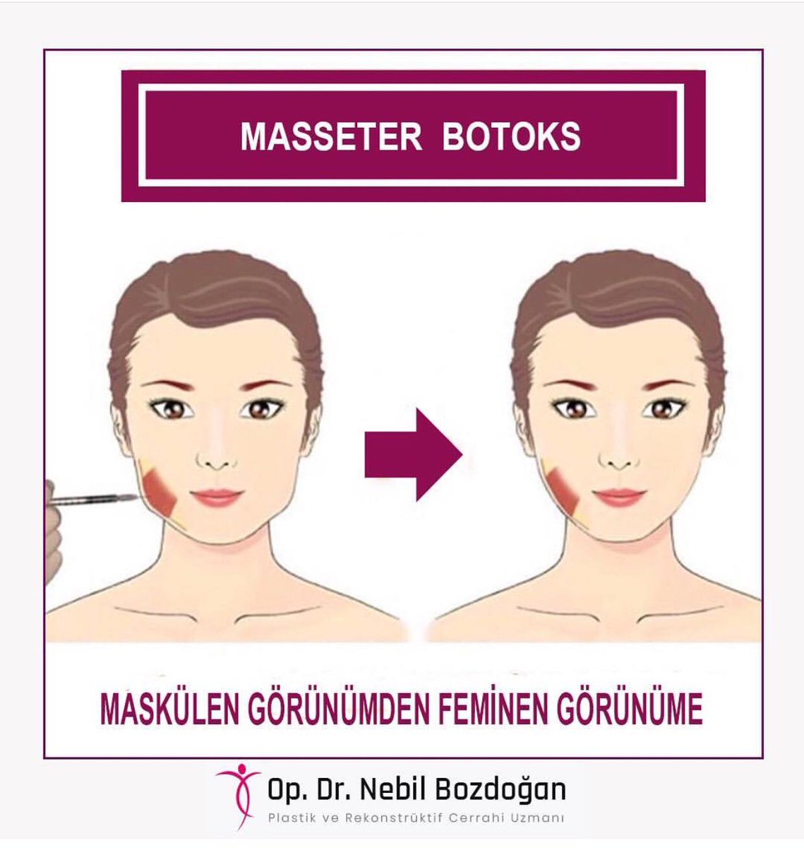 OpBozdogan's tweet photo. #liposuction #jinokomasti #göğüsestetiği #göğüsbüyütme #göğüsdikleştirme #rinoplasti #gözkapağıestetiği #ankara #bilgi #iletişim #ameliyatsizburunestetiği #ışıltıdolgusu #gençlikaşısı #saçbakımı #tamkarıngermeameliyatı #açıkrinoplasti #masseterbotox https://t.co/4kR0HVTvW1