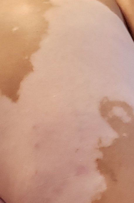 dapurplediva's tweet photo. my #Vitiligo dont Own..me I own #MySkinCondition I #WillNotHideMyVitiligo #ItsSoRareTheyStare #Borndifferentππ #BeautybothWaySππ I roc I make it look Eaze #VitiligoStrong Lake Charles Louisiana https://t.co/tiDCfJPAUr