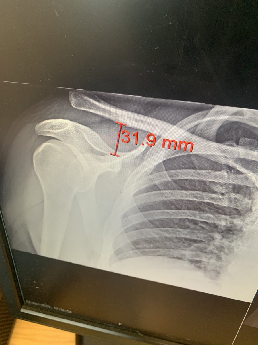 PlumbJet1's tweet photo. Our operations manager did this on Tuesday had a major operation Friday morning having a plate and screws fitted put put the bone back in place and tells us he will be back in work on Monday #soldier #likeaboss he loves his job https://t.co/PQn2KYtkeM