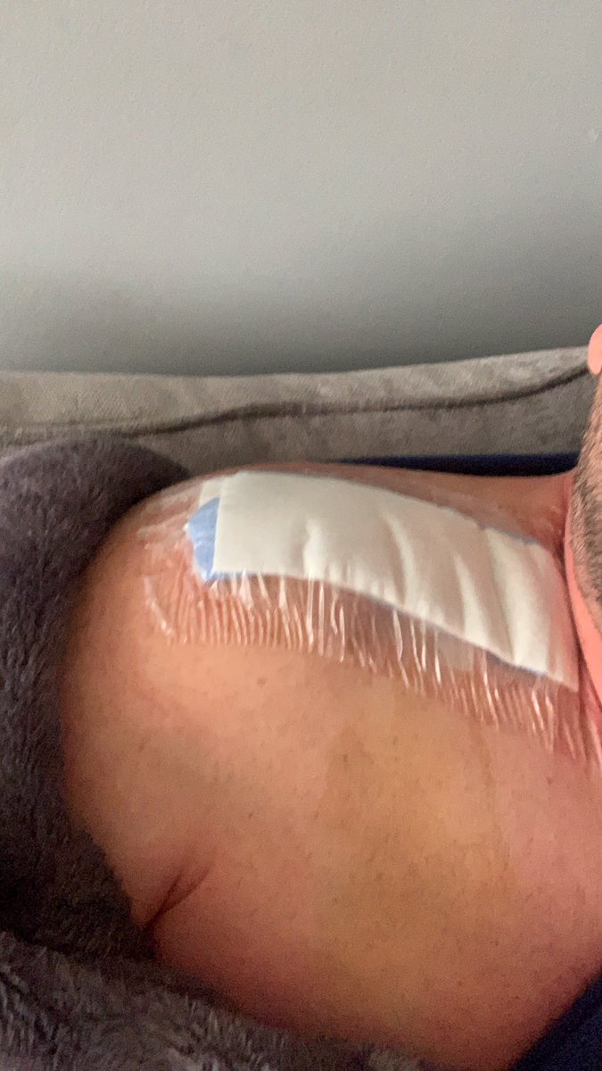 PlumbJet1's tweet photo. Our operations manager did this on Tuesday had a major operation Friday morning having a plate and screws fitted put put the bone back in place and tells us he will be back in work on Monday #soldier #likeaboss he loves his job https://t.co/PQn2KYtkeM