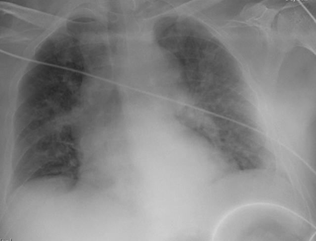 ICS_updates's tweet photo. Online first from #journalics: A case of multi-organ failure due to hyperparathyroidism-related hypercalcaemia
https://t.co/H9KnTcTvBG
#foamed #foamcc https://t.co/bmtLUcqBhZ