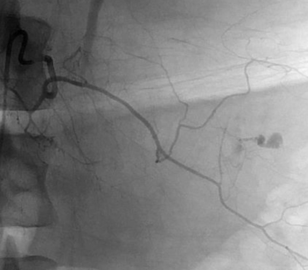 DkimMD's tweet photo. Retroperitoneal hematoma with brisk arterial extravasation from a left L2 lumbar artery branch vessel successfully embolized @maninbsir @WashUIR #irad https://t.co/6p3bKgiZjz