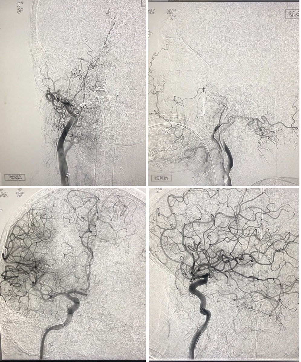 As an IR tech we rarely see the outcome on a grand scale because we don’t get to see patients in clinic for follow up. Strokes are something where we can have that instant gratification. I’m proud to be apart of a great team.  #iRad #womeninIR #patientsfirst #NeuroIR