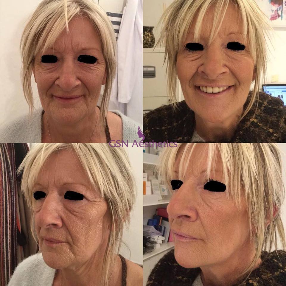 An amazing before (left) and after using #wrinklerelaxers! 😍 Our client looks completely natural yet totally rejuvenated. 💜💉 #Sidcup #Blackfen