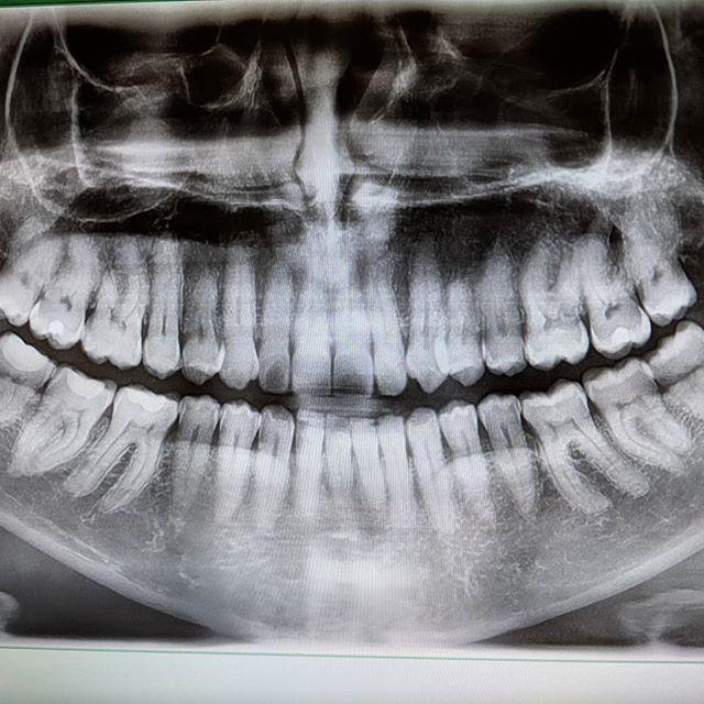 mattkosoy's tweet photo. Bye bye wisdom teeth⚡🐢 #stealyourface https://t.co/fUM0RcXCf3