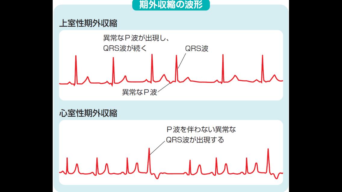 収縮 上 外 性 室 期 頻発性上室性期外収縮とは？una、心電図で要精密検査！