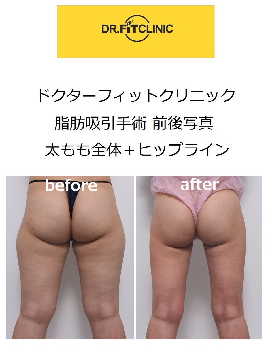 OfficialClinic's tweet photo. ドクターフィットクリニック
脂肪吸引手術 前後写真②

「　太もも＋ヒップライン　」

#韓国 #脂肪吸引 #ドクターフィット
#닥터핏 #지방흡입 #韓国脂肪吸引 #before #after https://t.co/KOBc2ag1lE
