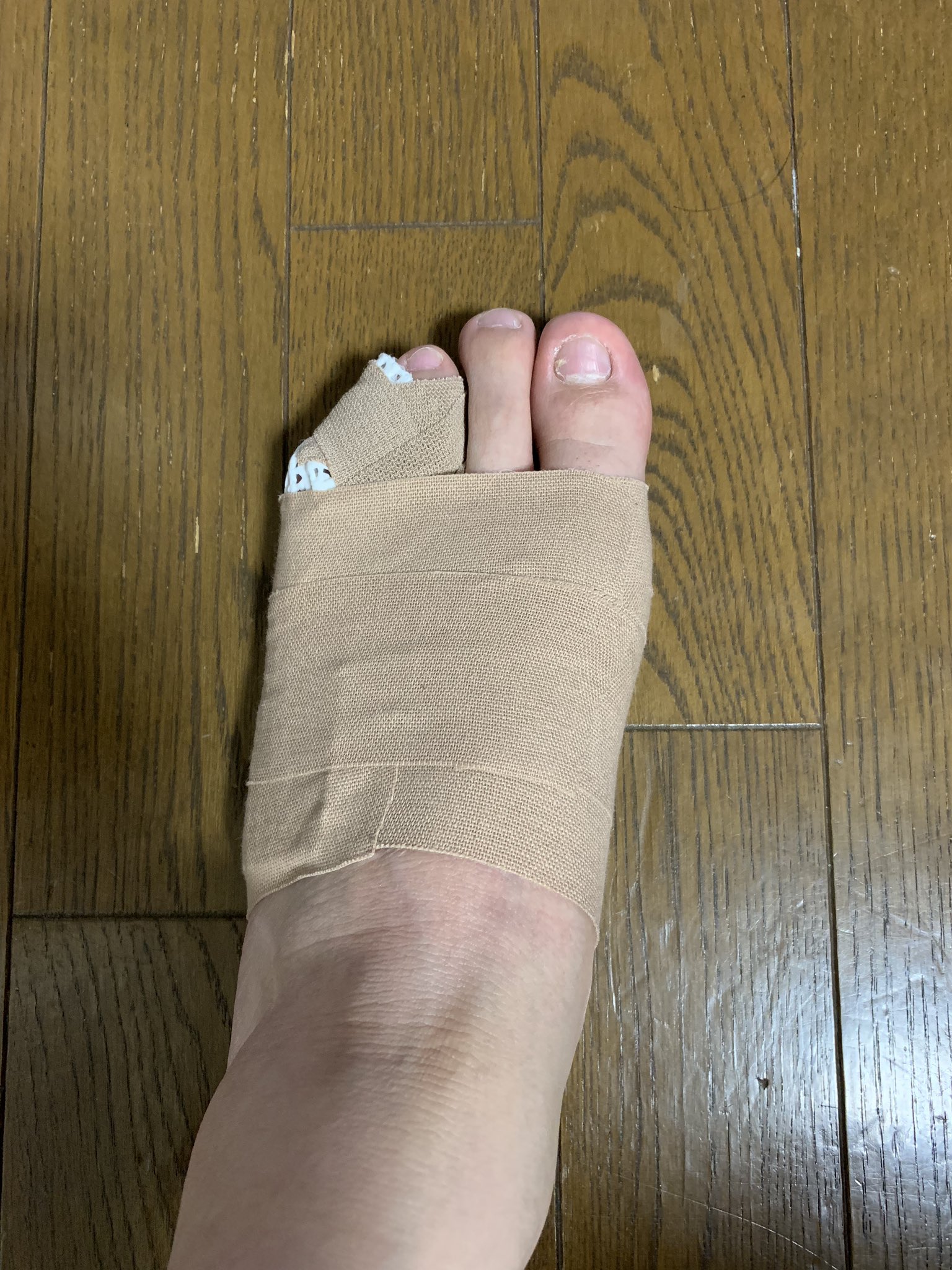 じんじん 末節骨骨折全治4週間 はぁー W T Co Xxjrlpe8cz Twitter