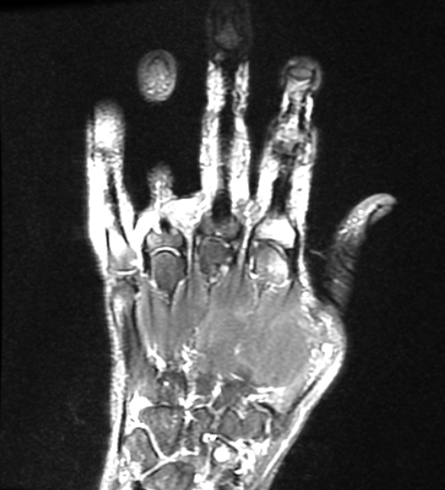 DrPomeranz's tweet photo. This week, we present you with a hand case! Click on the following link to scroll through every image in the case: https://t.co/akHOSyPGYA
Hx: This 67-year-old male presents with palmer mass near the base of the thumb on left hand.
#RadRes #Radiology #MRI #HandMRI https://t.co/RslCQJyA4M
