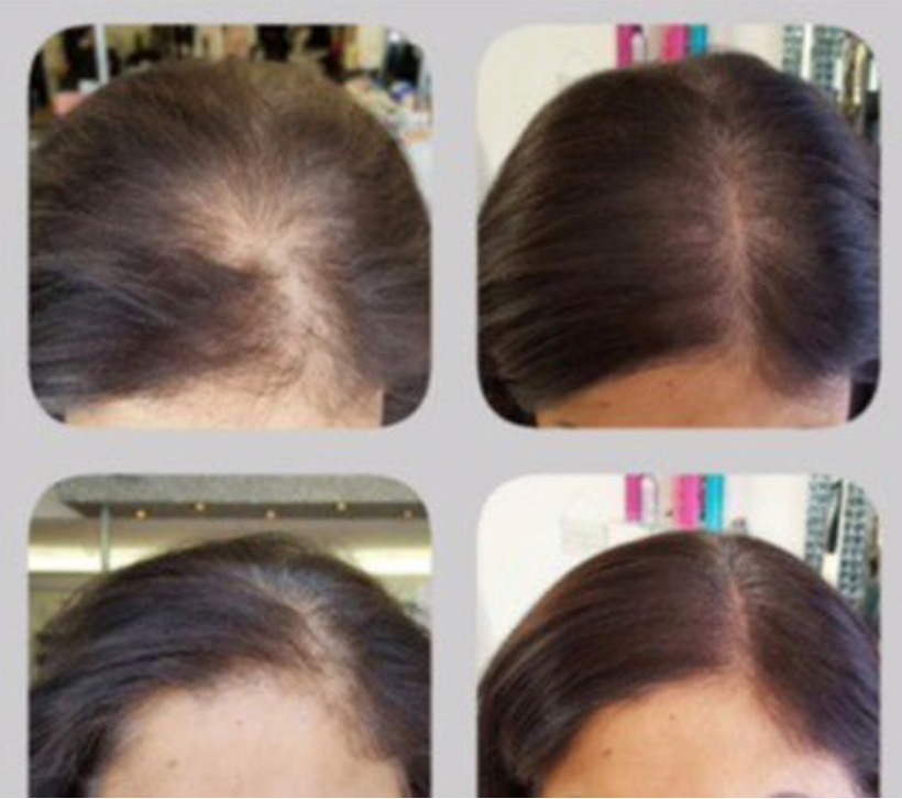 AMPskinandlaser's tweet photo. Look at the results our Scalp Confidential team can achieve! If you suffer from hair loss our team are waiting. Book a free consultation at our clinic on 1 May &amp; hear about treatment options available #hairloss #hairrestoration #scalpconfidential #micropigmentation #misotherapy https://t.co/aoqRZQxq95