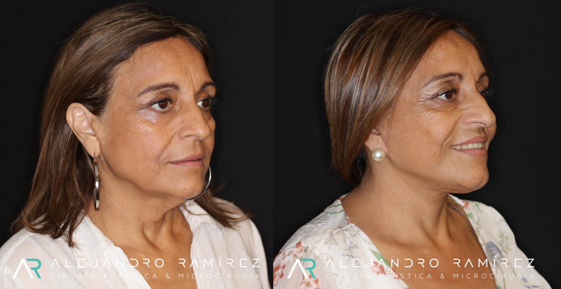 Lifting Facial Resultado natural - Alejandro Ramírez