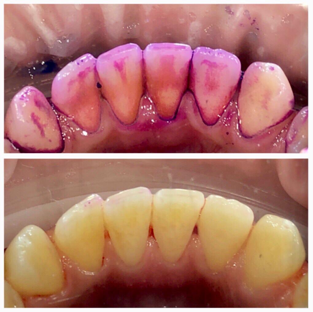 Not only have I had the absolute pleasure of spending the day with <a href="/LondonHygienist/">Anna Middleton</a> but I also had a cheeky treatment #GBT #EMS #Smile