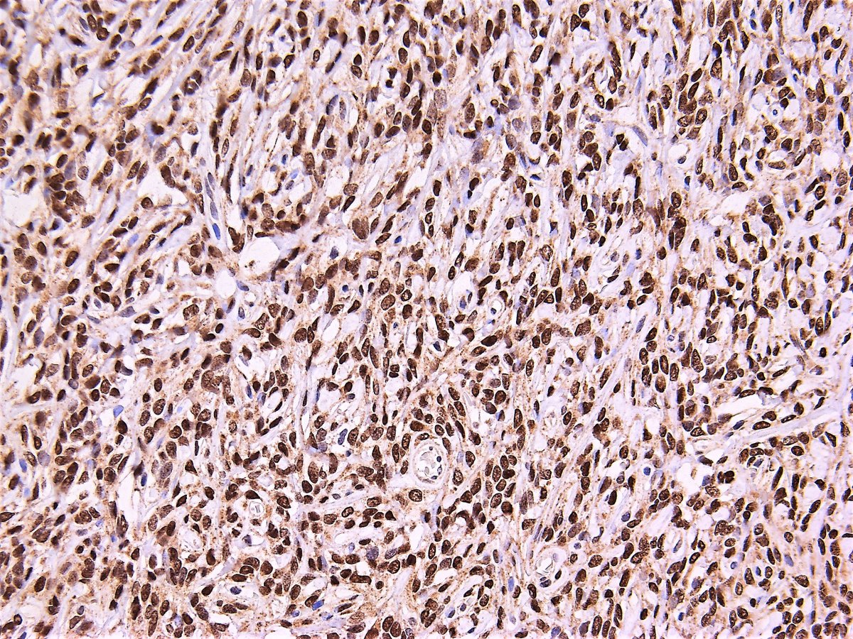 Patholwalker's tweet photo. Solitary fibrous tumor/Hemangiopericytoma, WHO grade I. Cerebrum, tumorectomy. HE, CD34 and STAT6. #pathology https://t.co/opiJqI5wqu