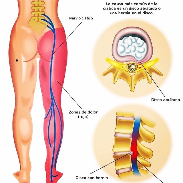 vcalderonosteo's tweet photo. Hernia discal lumbar.
#osteopath #osteopathy #PonUnOsteópataEnTuVida #osteopata #osteopatia #osteópata #osteopatía #magoun #upledger #sutherland #violafrymann #torstenliem #andrewtaylorstill https://t.co/pxmCUfFiwe