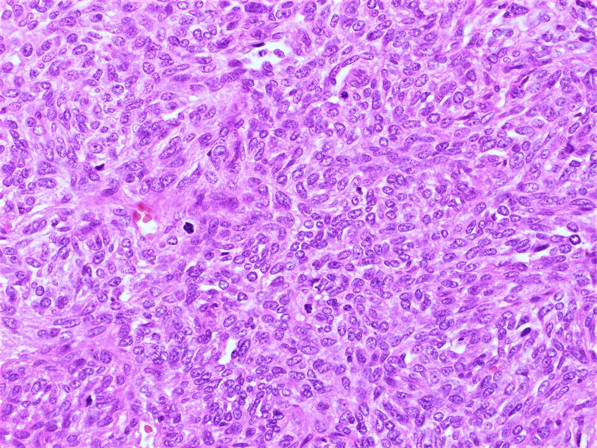 Patholwalker's tweet photo. Solitary fibrous tumor/Hemangiopericytoma, WHO grade III. Cerebrum, tumorectomy. #pathology #neuropath https://t.co/yGFsFhLnU4