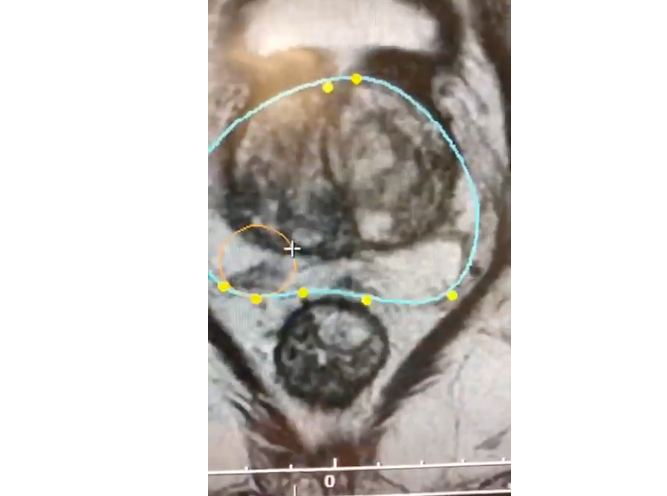 HIFUClinic's tweet photo. Biopsja fuzyjna przezkroczowa to najnowocześniejsze badanie diagnostyczne w przypadku raka prostaty - badanie jest już dostępne w HIFU CLINIC. #biopsjaprostaty #biopsjafuzyjna #hifuclinic https://t.co/IXaLWLcbWM https://t.co/jNFMdzOBkW
