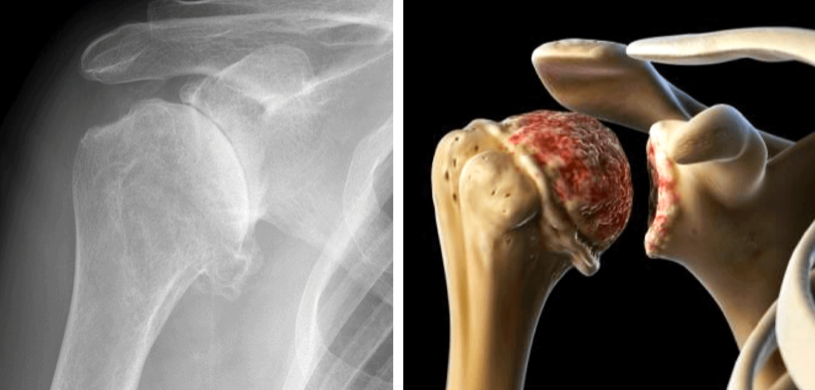 orthodocjones's tweet photo. There can be many challenges to total #ShoulderArthroplasty in patients with #arthritis. Watch to learn what those challenges are and how Dr. Jones tackles them.
https://t.co/1tBFMO1iXH
#ColoradoSprings #CoSportsDoc #SportsMedicine #TotalShoulderReplacement https://t.co/LbzhOzK6q0
