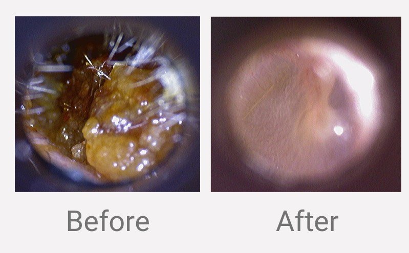All Ears on Twitter: "Some lovely before and after images of Microsuction Ear Wax Removal to brighten up your Monday 👂👂 📞07961 604782 📨info@allearswales.co.uk 🌐https://t.co/3WJeP52KQb https://t.co/E9rOj4rMe6" / Twitter