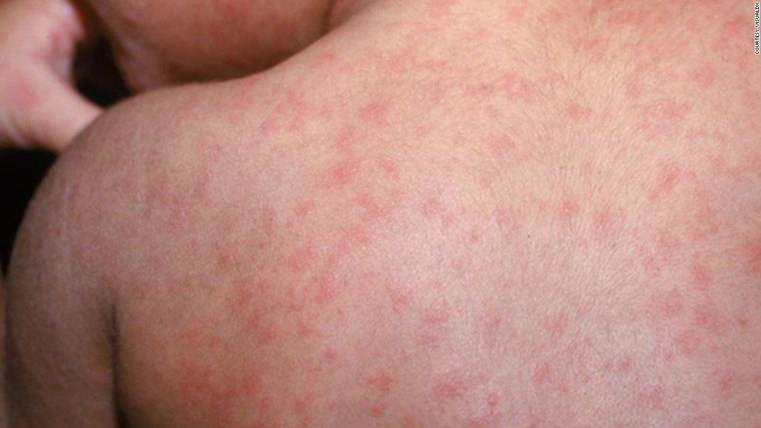 CNN's tweet photo. The CDC says 78 new cases of measles were reported in the US last week. That's at least 465 this year for a disease that the US considered eliminated in 2000. https://t.co/zqf3oUSEp9 https://t.co/9FjkZfXALj