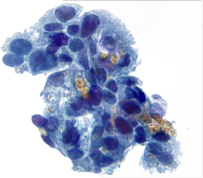 PatMcIntireMD's tweet photo. Urine cytology specimen from 68 M with BPH and microscopic hematuria. 

What are these cells (see poll)?

Pics: @pambuccian https://t.co/O8cle70Iti