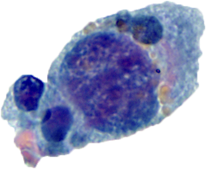 PatMcIntireMD's tweet photo. Urine cytology specimen from 68 M with BPH and microscopic hematuria. 

What are these cells (see poll)?

Pics: @pambuccian https://t.co/O8cle70Iti
