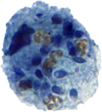 PatMcIntireMD's tweet photo. Urine cytology specimen from 68 M with BPH and microscopic hematuria. 

What are these cells (see poll)?

Pics: @pambuccian https://t.co/O8cle70Iti