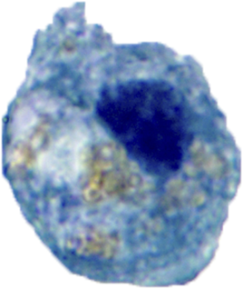 PatMcIntireMD's tweet photo. Urine cytology specimen from 68 M with BPH and microscopic hematuria. 

What are these cells (see poll)?

Pics: @pambuccian https://t.co/O8cle70Iti