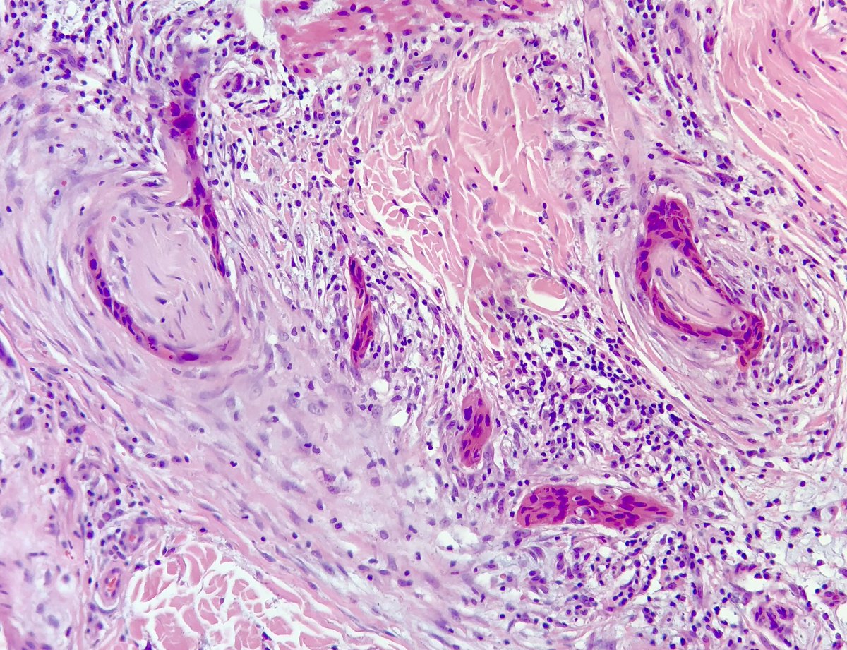 estheryoud's tweet photo. Amazing examples of perineural invasion in skin squamous cell carcinoma #pathology #dermpath #wearsunscreen https://t.co/UVZQMn385W
