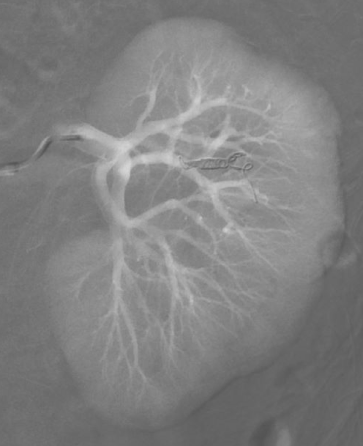 DkimMD's tweet photo. Grade IV renal laceration in a patient status post fall down stairs - successfully treated with coil embolization @WashUIR @Duncan_JRD https://t.co/mvMnHPytJJ