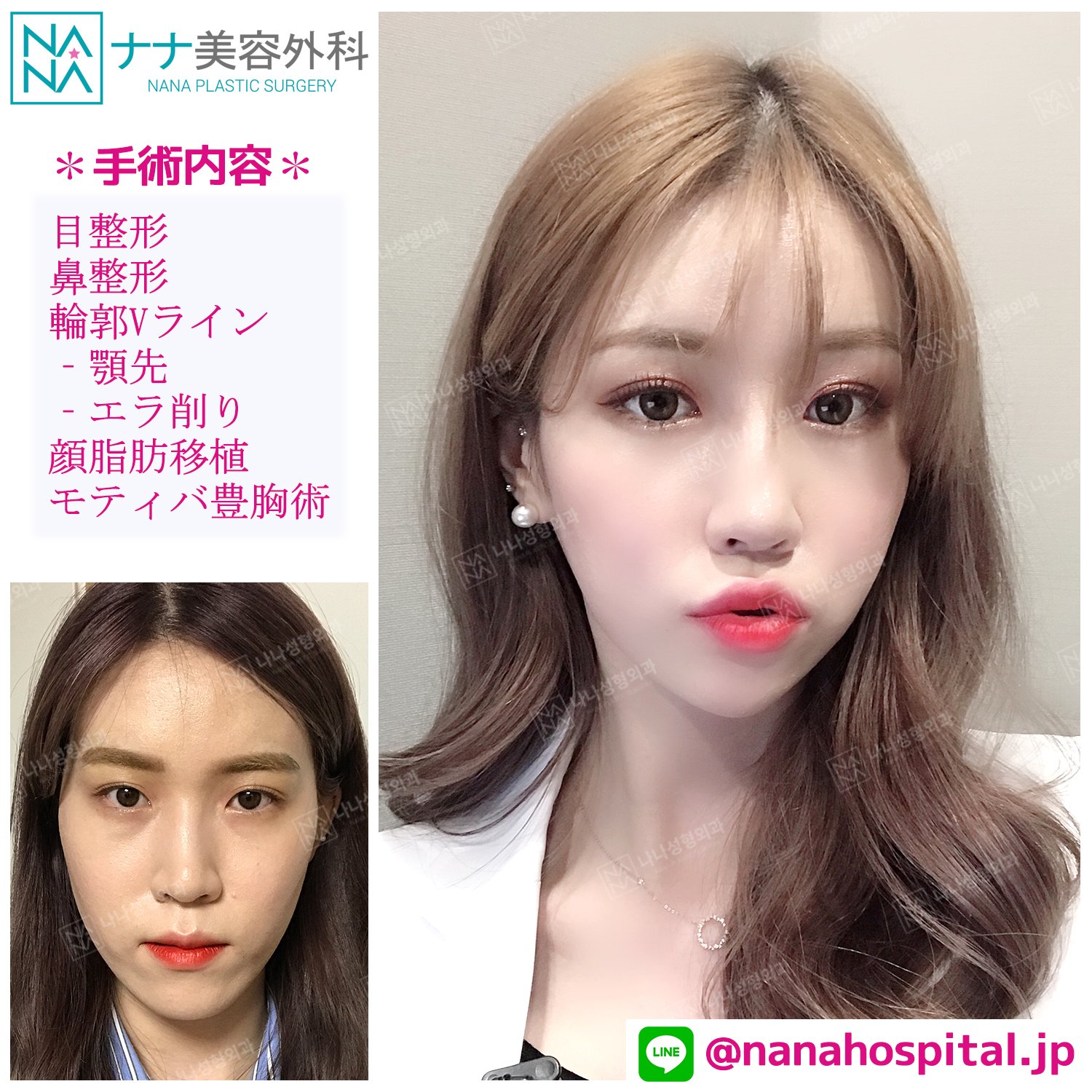 韓国NANA美容整形外科【公式】 on X: 韓国NANA美容整形外科【公式】 on X: