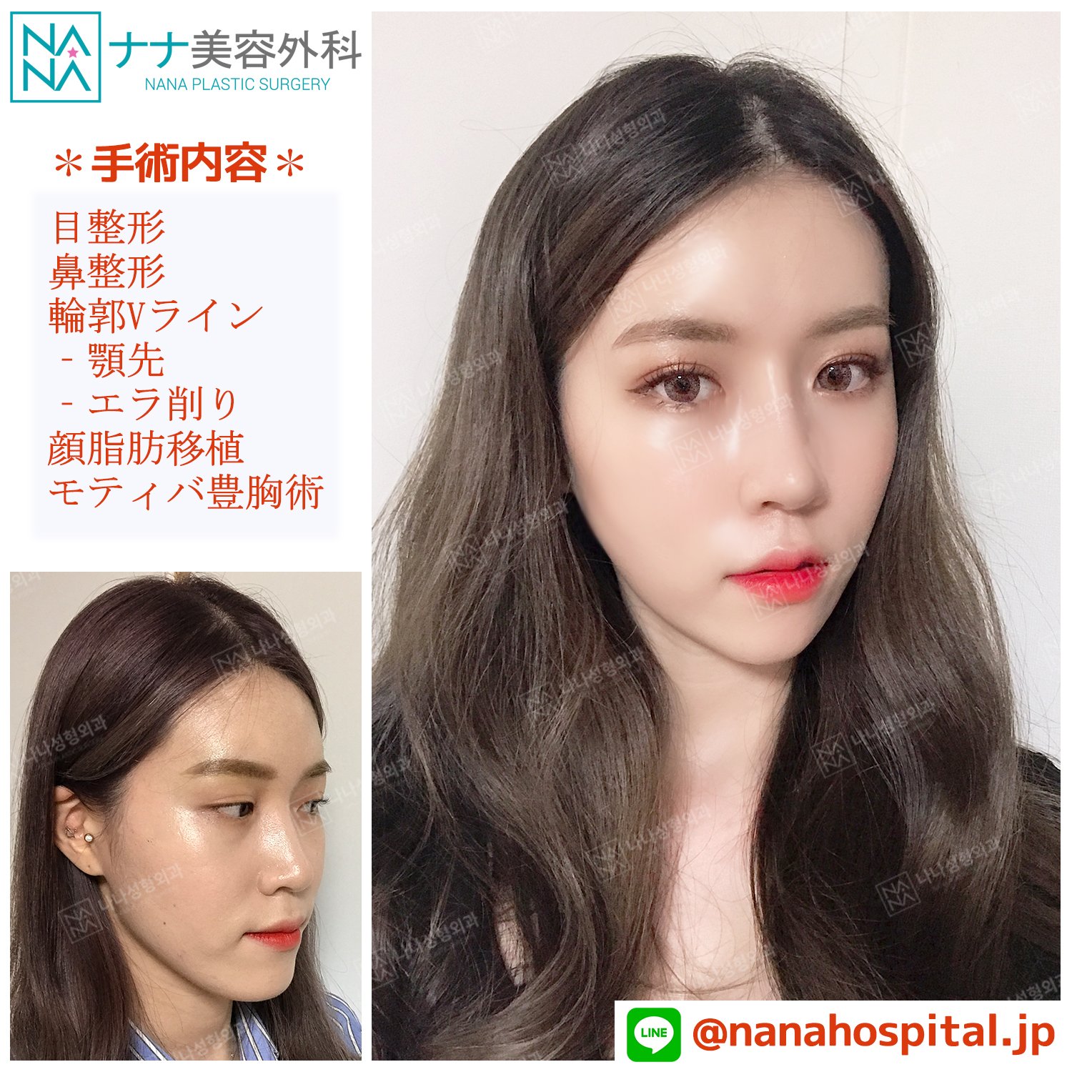 韓国NANA美容整形外科【公式】 on X: 韓国NANA美容整形外科【公式】 on X:
