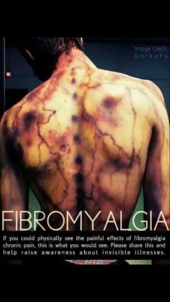 RT please? I regularly get asked what #fibromyalgia feels like or how I’m feeling. So I just show this picture: