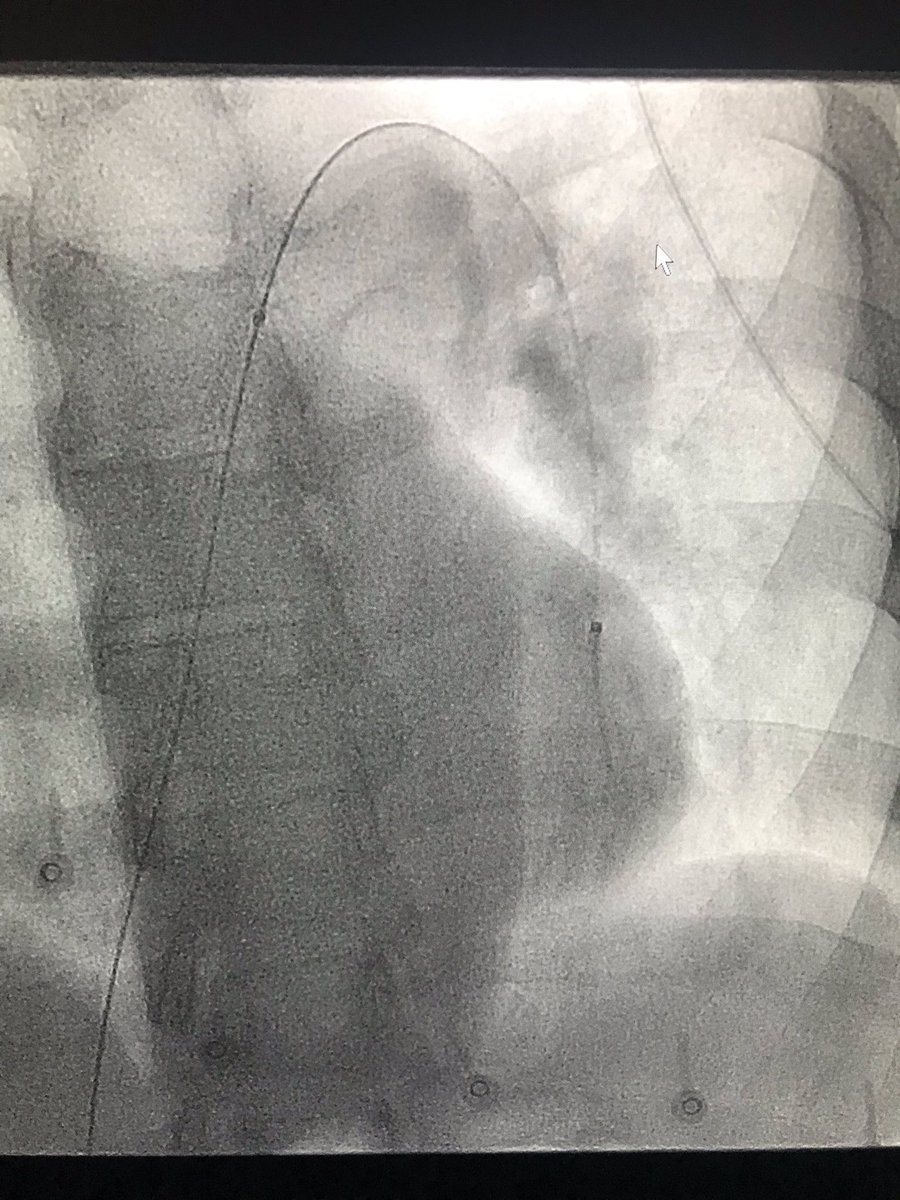 BSIR_News's tweet photo. Pulmonary catheter directed thrombolysis is a minimally invasive life saving technique. #IRad #pinholesurgery #withoutascalpel
IR is a key part of the patient pathway . Best outcomes are achieved via effective team work
#thrombolysis
@mo_hamady @Imperialnhs @cirsesociety https://t.co/ApPcb0xeSD
