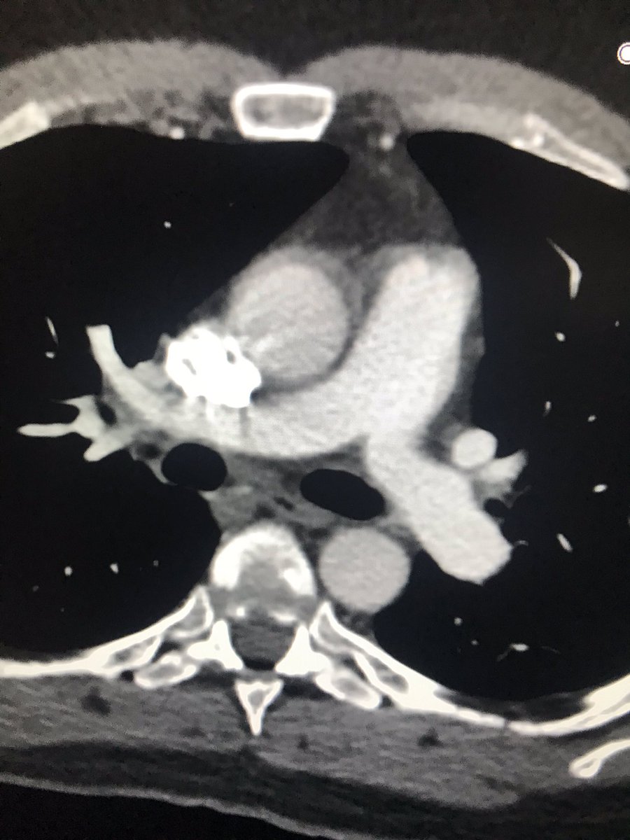 BSIR_News's tweet photo. Pulmonary catheter directed thrombolysis is a minimally invasive life saving technique. #IRad #pinholesurgery #withoutascalpel
IR is a key part of the patient pathway . Best outcomes are achieved via effective team work
#thrombolysis
@mo_hamady @Imperialnhs @cirsesociety https://t.co/ApPcb0xeSD