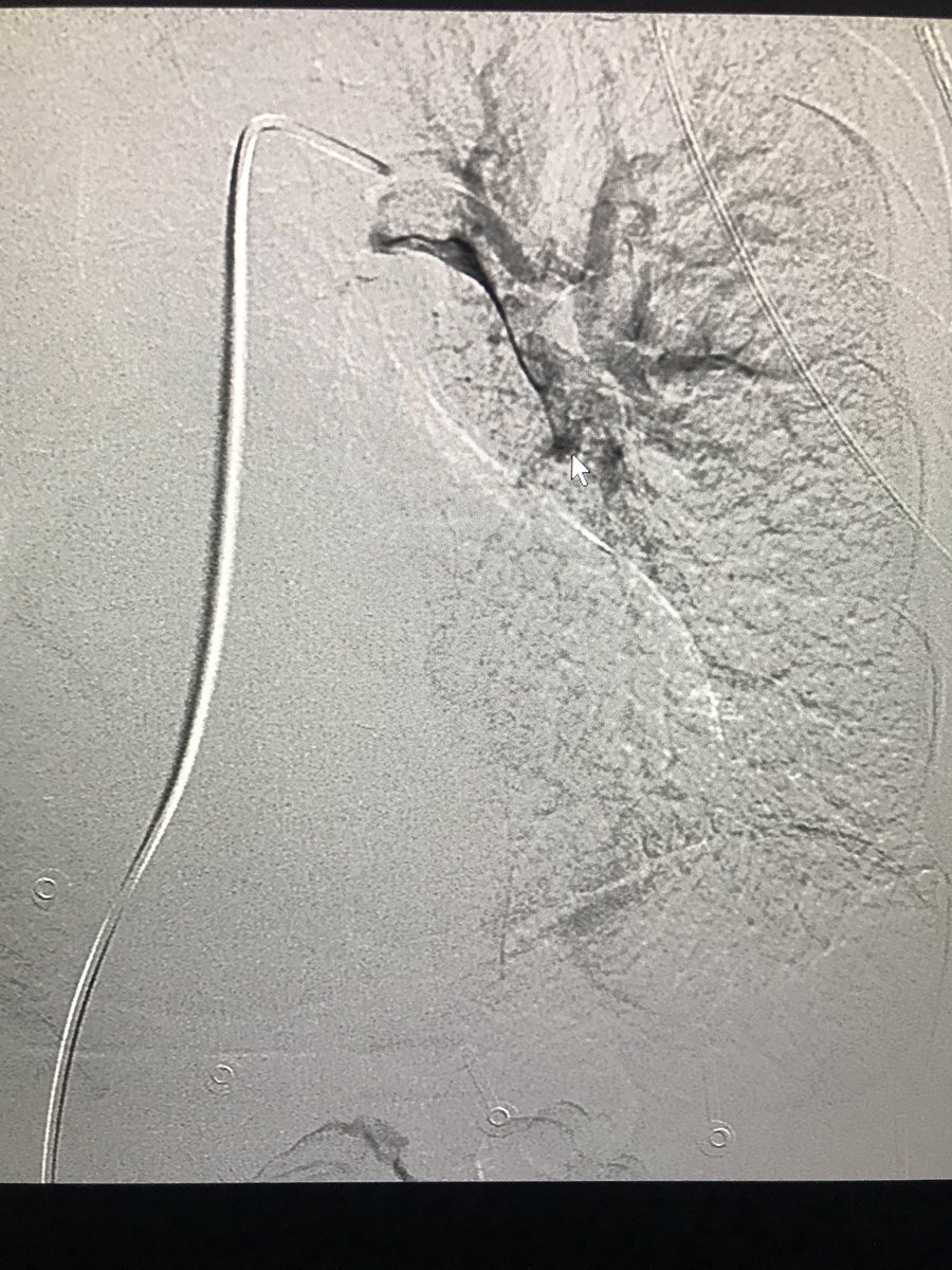 BSIR_News's tweet photo. Pulmonary catheter directed thrombolysis is a minimally invasive life saving technique. #IRad #pinholesurgery #withoutascalpel
IR is a key part of the patient pathway . Best outcomes are achieved via effective team work
#thrombolysis
@mo_hamady @Imperialnhs @cirsesociety https://t.co/ApPcb0xeSD