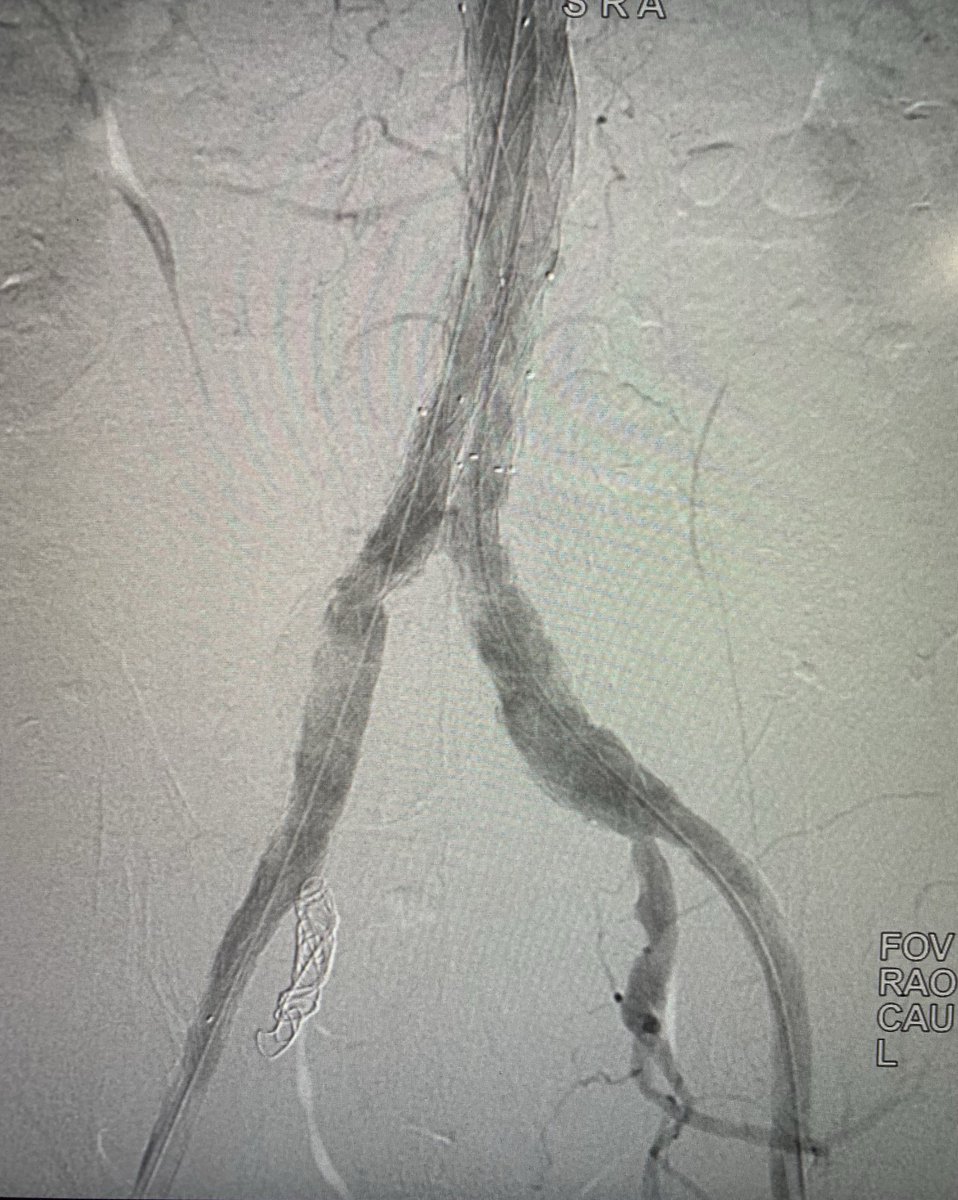 Dr Ahmad Ameer Na Twitteru قسطرة الشريان الاورطي تعتبر حلا لمشكلة تمدد الشريان الاورطي البطني في السابق كانت تعالج بفتح البطن وعملية تحتاج إقامة طويلة في المستشفى الان نعالجها بالقسطرة بنتائج
