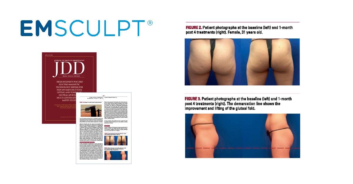 NaturalLookFL's tweet photo. The December 2018 JDD Study found 85% of the 75 patients had a significant improvement in the appearance of their buttocks after the fourth treatment. In addition, ALL patients reported their buttocks felt more lifted and toned #Emsculpt #muscle #bodycontouring #btlaesthetics https://t.co/umrr5YBYGB