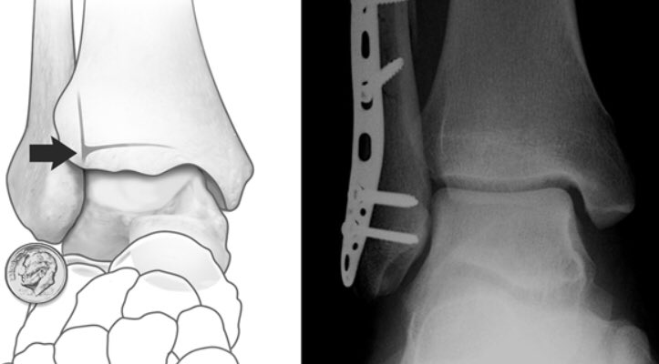 Sentavos Sign 🆘FRACTURAS DE TOBILLO🆘 ¿Como sabemos si el Peroné tiene la longitud ...