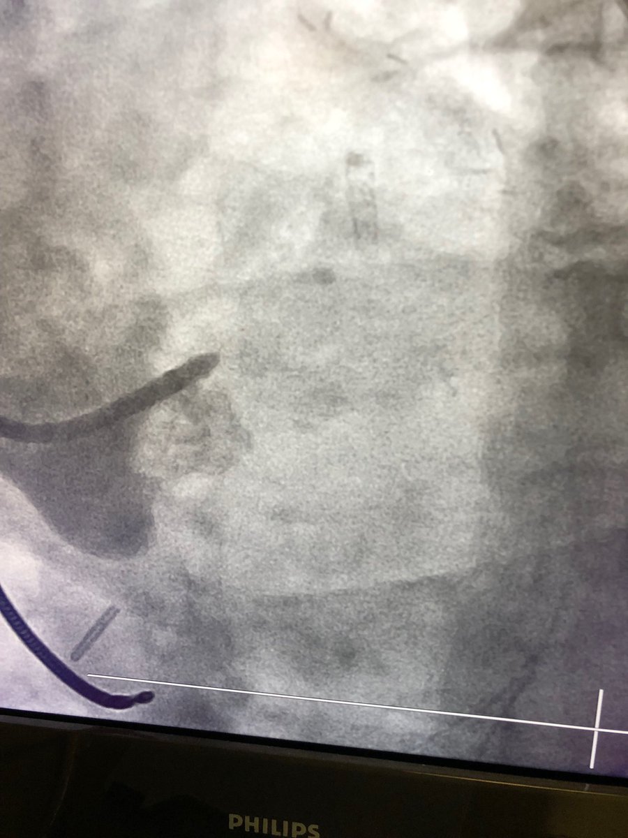 KeithNguyenSAIF's tweet photo. Retrograde cto intervention left main and lcx. https://t.co/RmmD2HYcEl